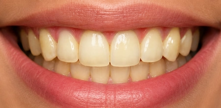 image comparison before